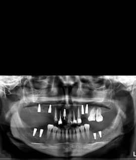 Dental implants surgery