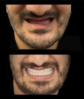 Surgery of impacted teeth