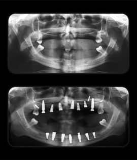 Dental implants surgery