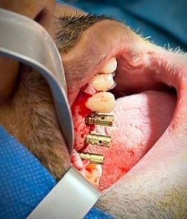 Dental implants surgery