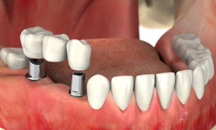 Dental implants surgery