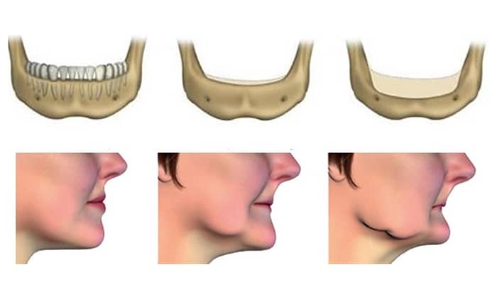 Maxillomandibular bone reconstruction