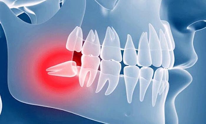 Surgery of impacted teeth