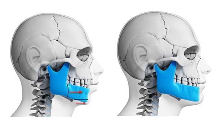 Orthognathic surgery