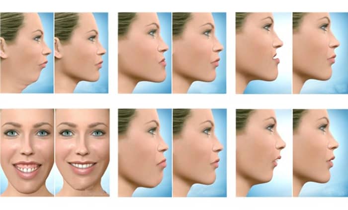 Treatment of facial bones fractures( trauma)