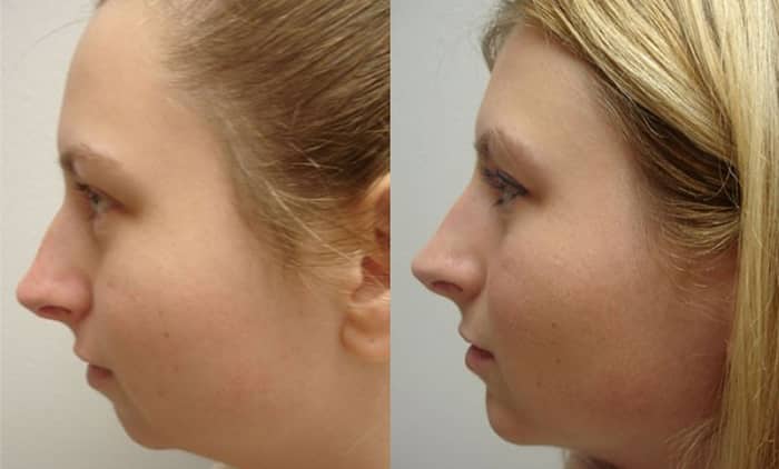 Facial prosthesis