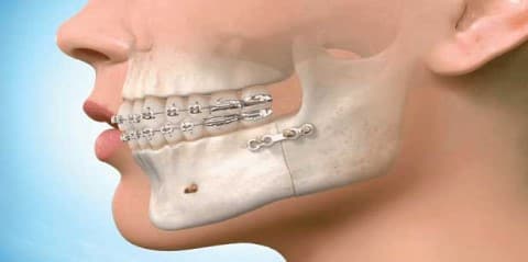 ارتباط ارتودنسی و جراحی فک