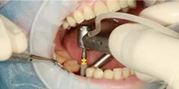 انواع جراحی داخل دهانی